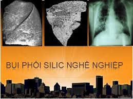 Bụi phổi Silic - Hình ảnh minh họa